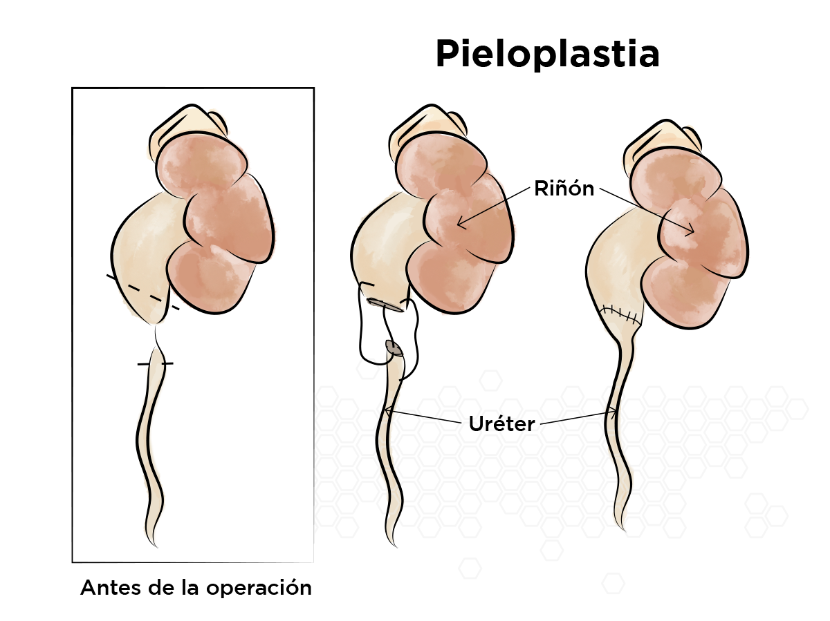 Pieloplastia